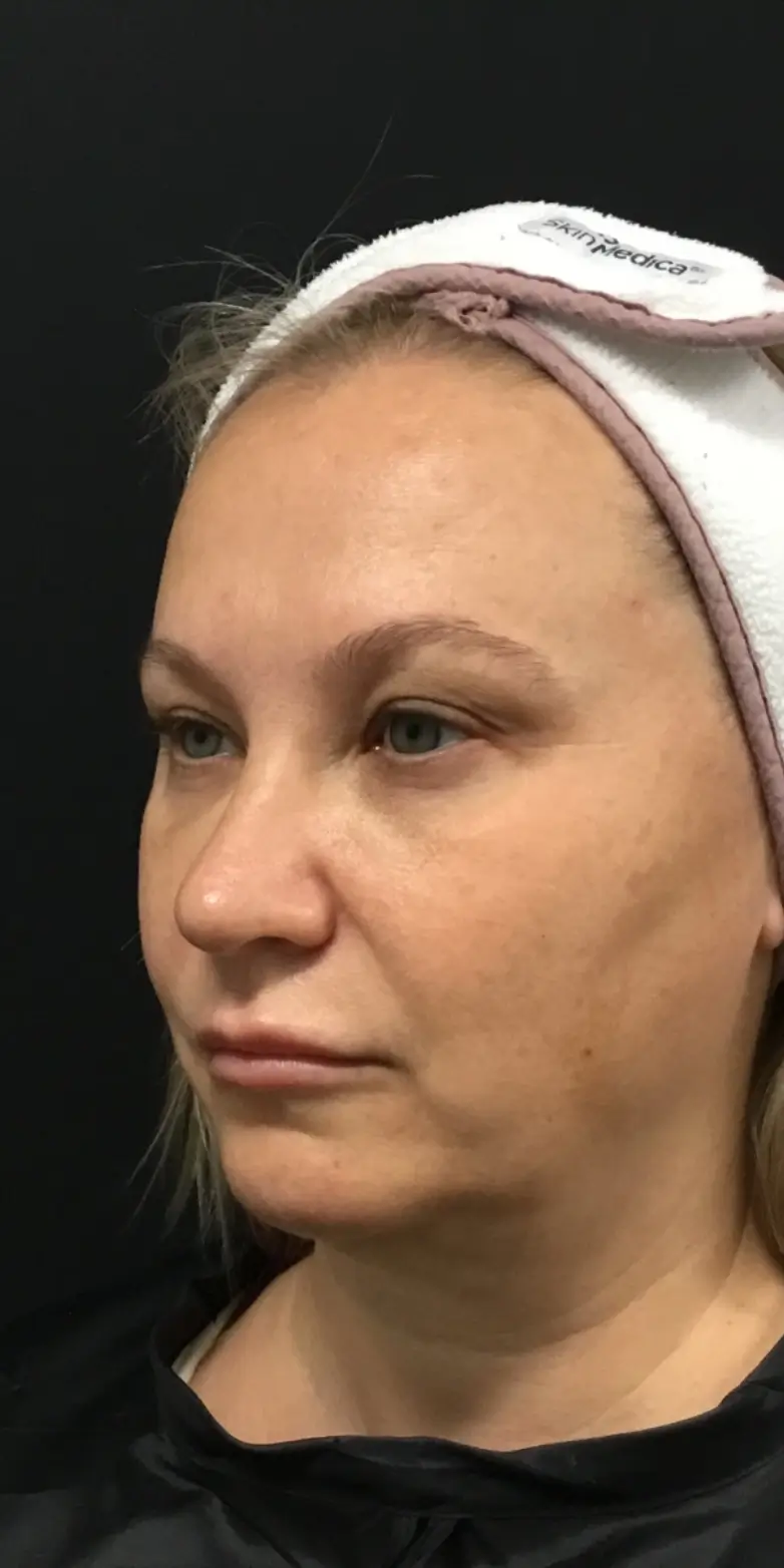 An after photo showcasing a female patient at Morpheus Santa Rosa Med Spa after her double chin treatment, highlighting the significant improvements in her profile.