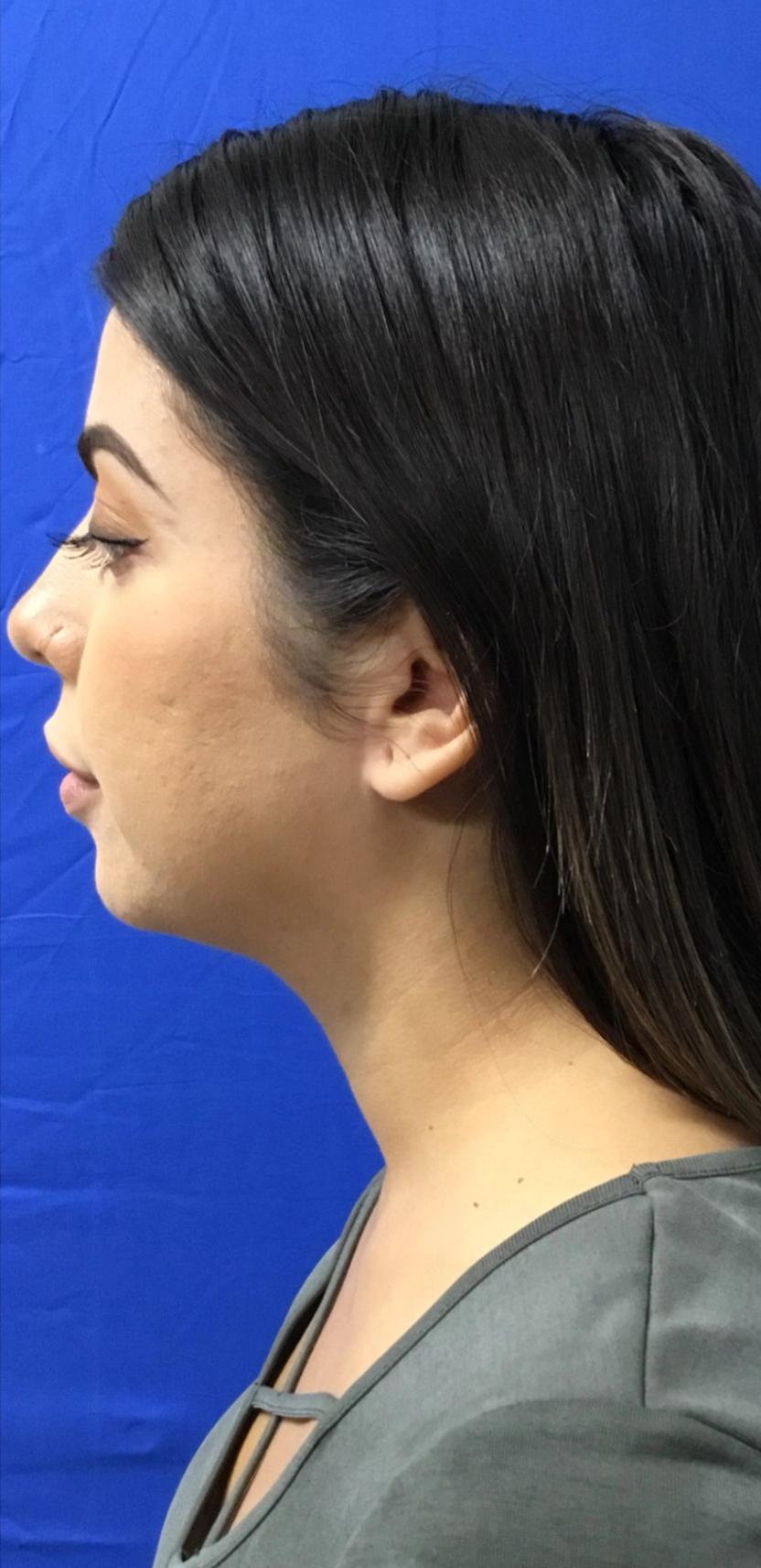 Chin after Kybella injections