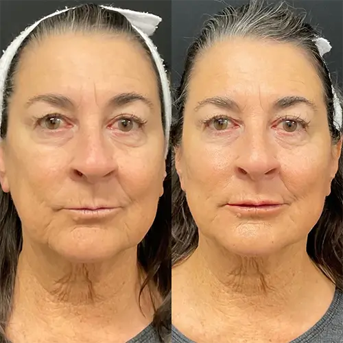Sculptra before and after photo of a patient