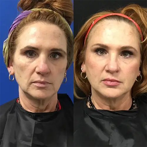 Sculptra before and after photo of a patient