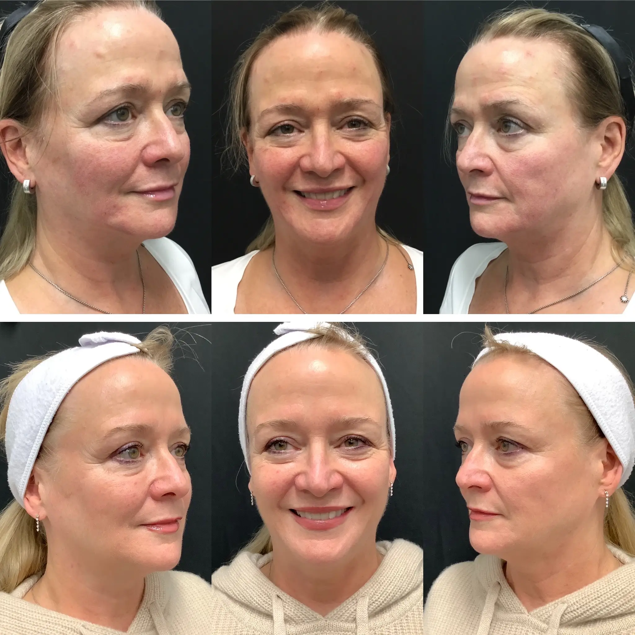 A collage featuring six photographs of a female patient from Morpheus Medical Spa in the Bay Area, showcasing significant improvement after receiving chemical peel treatment on her face.